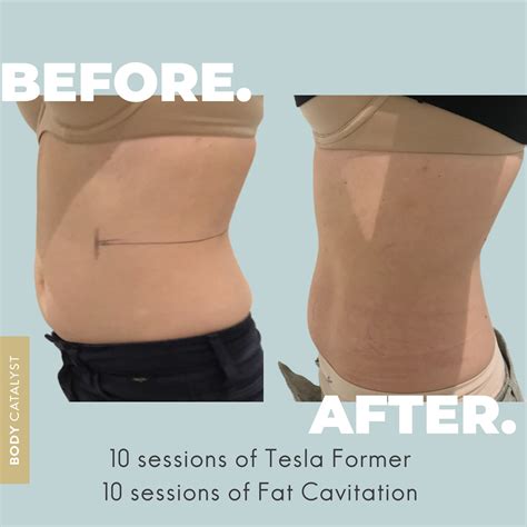 body shaping lane cove|Body Catalyst – Body Shaping And Wellness Experts.